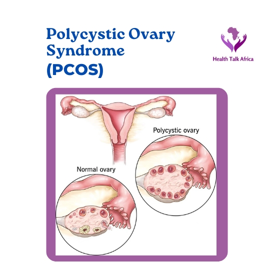 Polycystic Ovary Syndrome (PCOS)