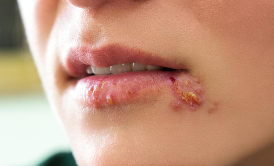 Herpes: Causes, Symptoms, and Prevention